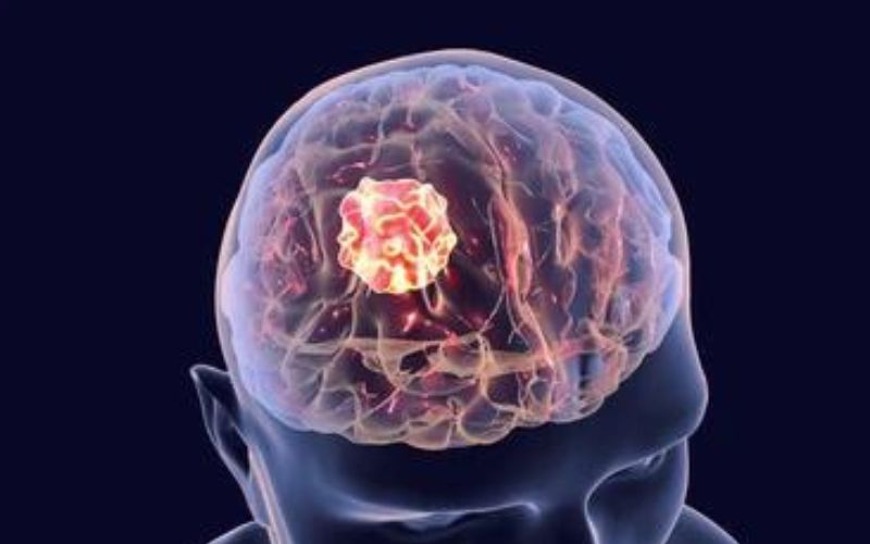 Reality of Living with a Brain Tumor – Symptoms, Diagnosis, and Treatment