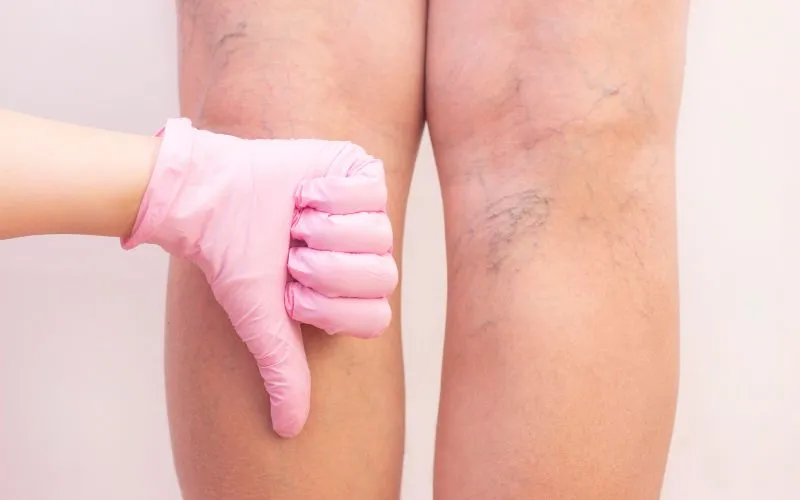 What is Peripheral Artery Disease? Causes, and Symptoms